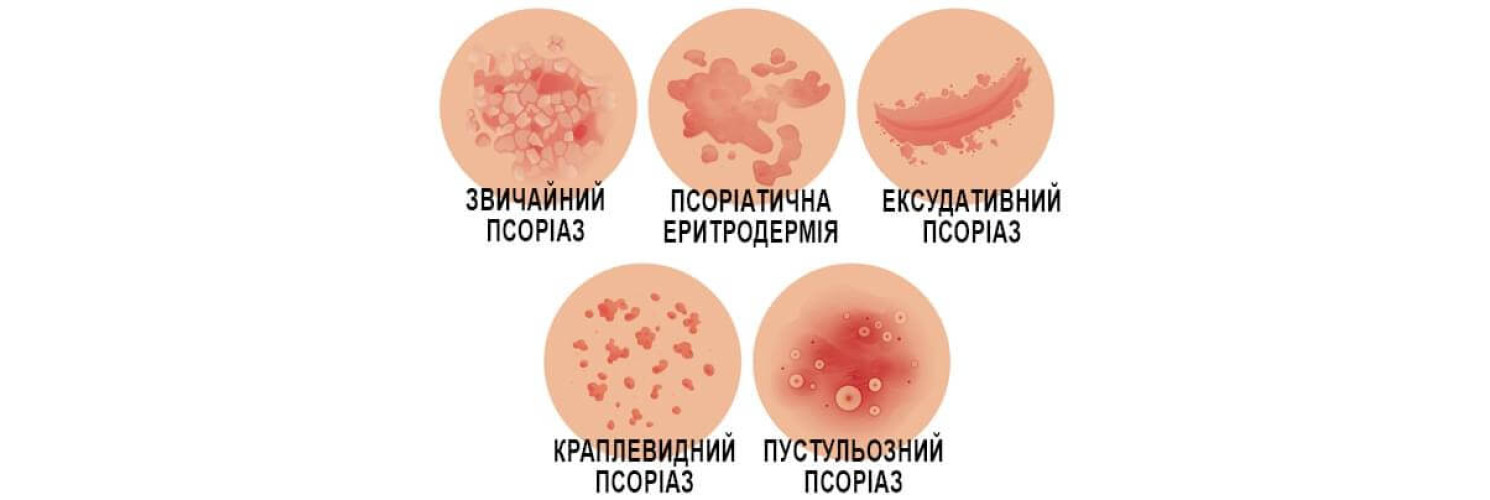 Види псоріазу